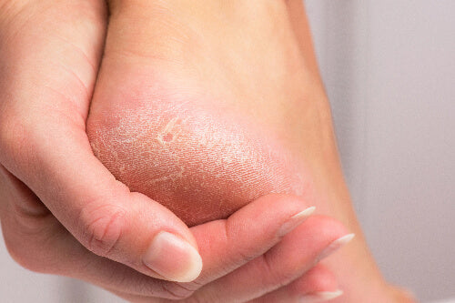 Callused feet