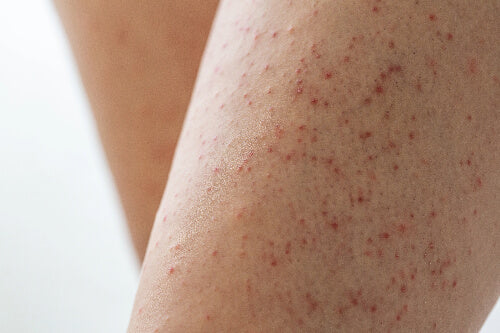 Keratosis