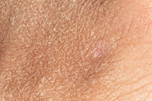 Dry Skin